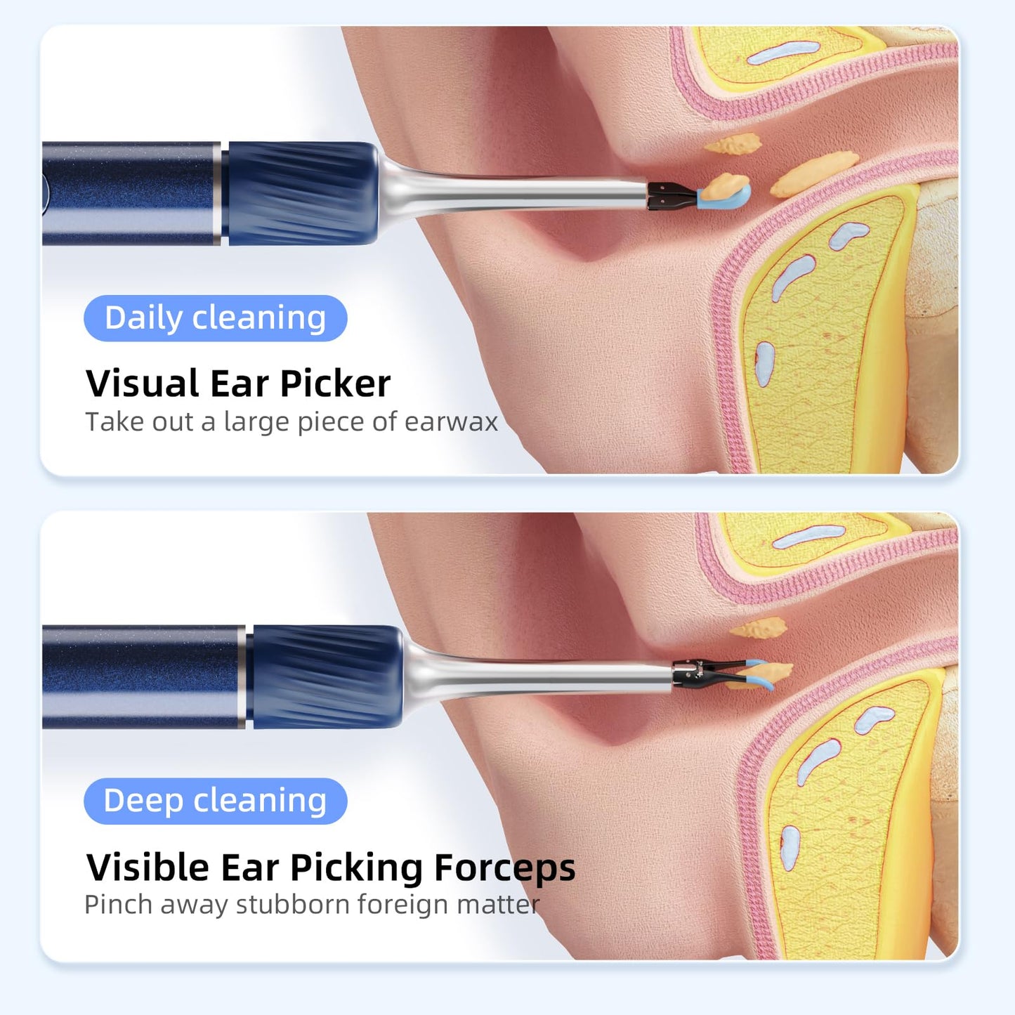 Qimic Ear Cleaner Camera with Tweezers - 1080P Ear Wax Removal with Light and Camera, IP67 Ear Camera, Ear Cleaner with Flexible Tweezers, Ear Camera Otoscope for iPhone, Android(Blue)