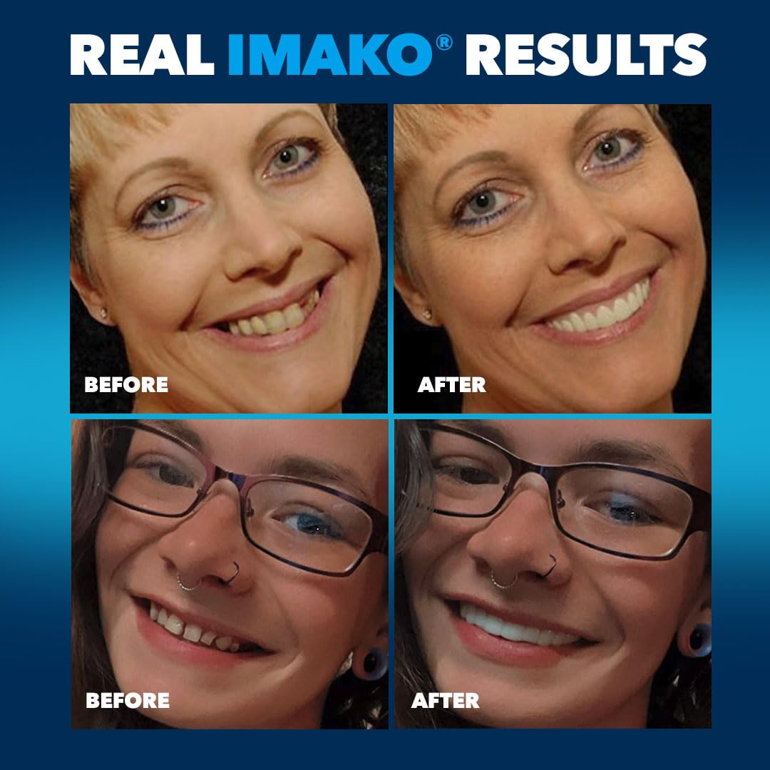 Imako Premium Cosmetic Uppers - 2 Pack - Large, Natural White - DIY Smile Makeover - Made in USA