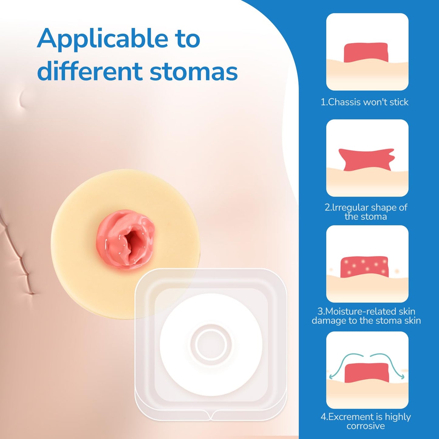 30 PCS Ostomy Barrier Rings, 2 mm Thickness Moldable Ostomy Rings Medical Grade Hydrocolloid Adhesive Barrier Rings Better Seal for Ostomy Bags (3 Box of 30)
