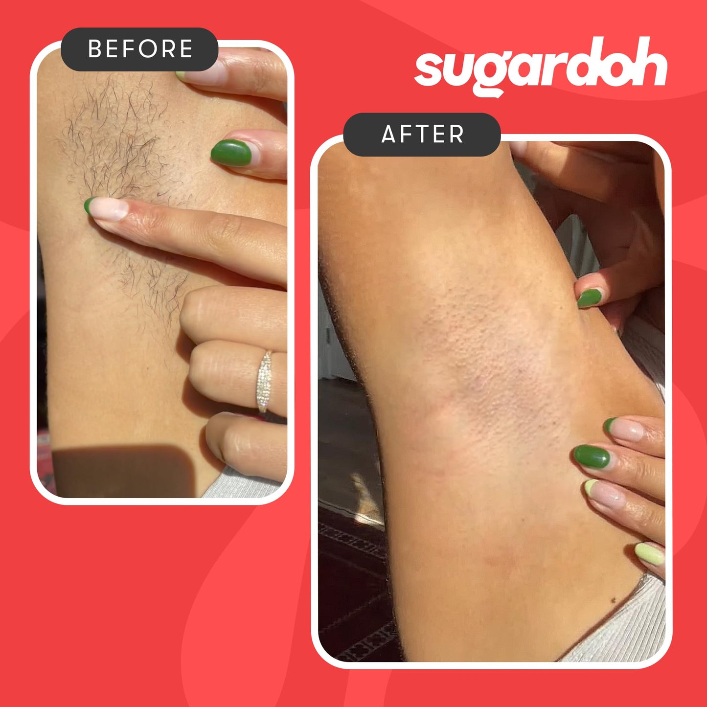 Sugardoh Sugar Waxing Kit for Women As Seen On Shark Tank (Mini Kit Medium) Face, Arms, & Legs, Sugar Wax Hair Removal- Sugaring Tiktok Viral Products- Bikini Wax Kit for Women - Sugaring Kit