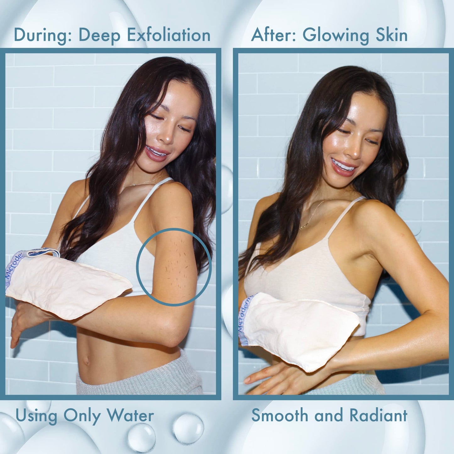 Microdermamitt Deep Exfoliating Mitt Bath Glove Mitten for Body Scrub - Best Dry Skin Treatment, - Remove Dead Skin, Keratosis Pilaris Bumps Instantly