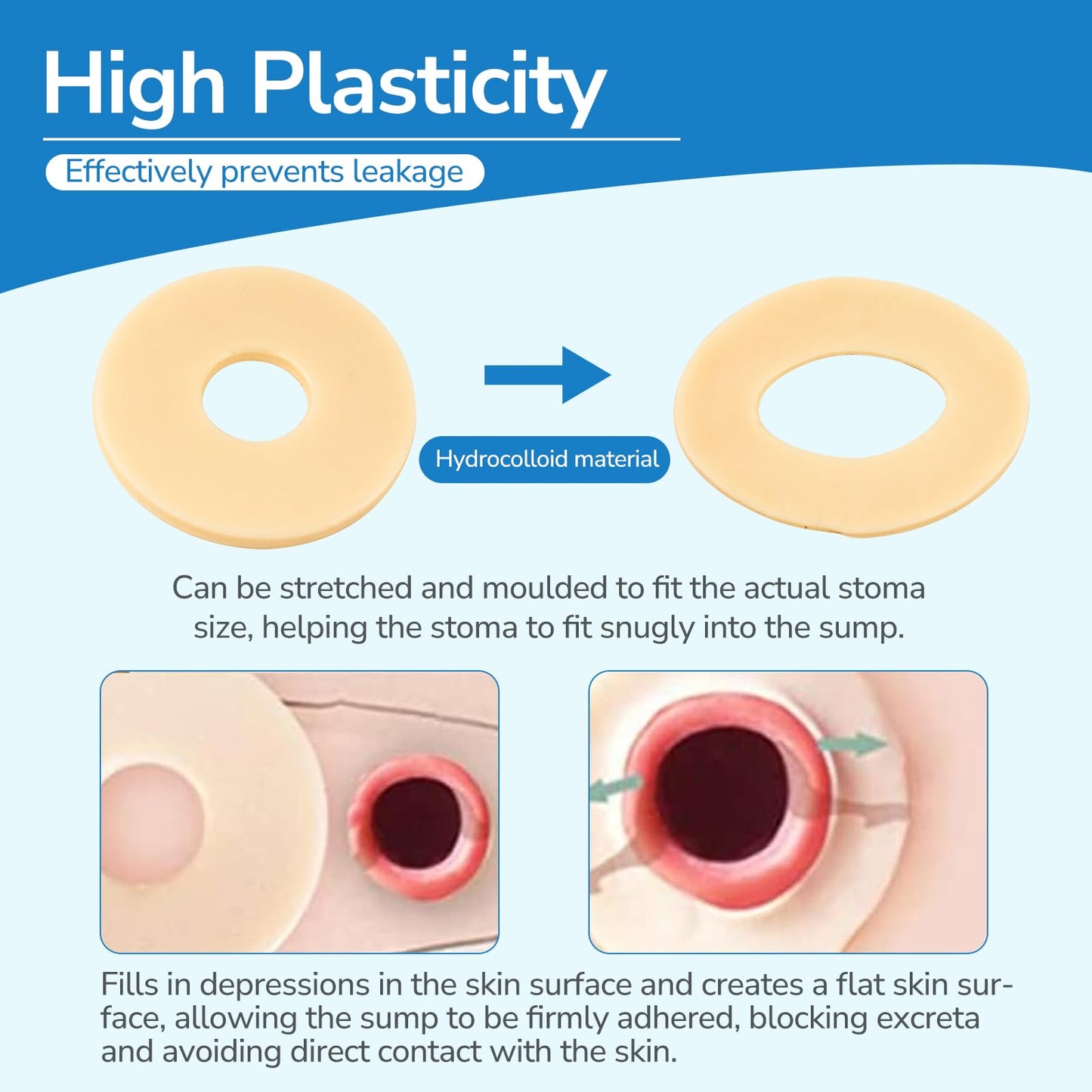 30 PCS Ostomy Barrier Rings, 2 mm Thickness Moldable Ostomy Rings Medical Grade Hydrocolloid Adhesive Barrier Rings Better Seal for Ostomy Bags (3 Box of 30)