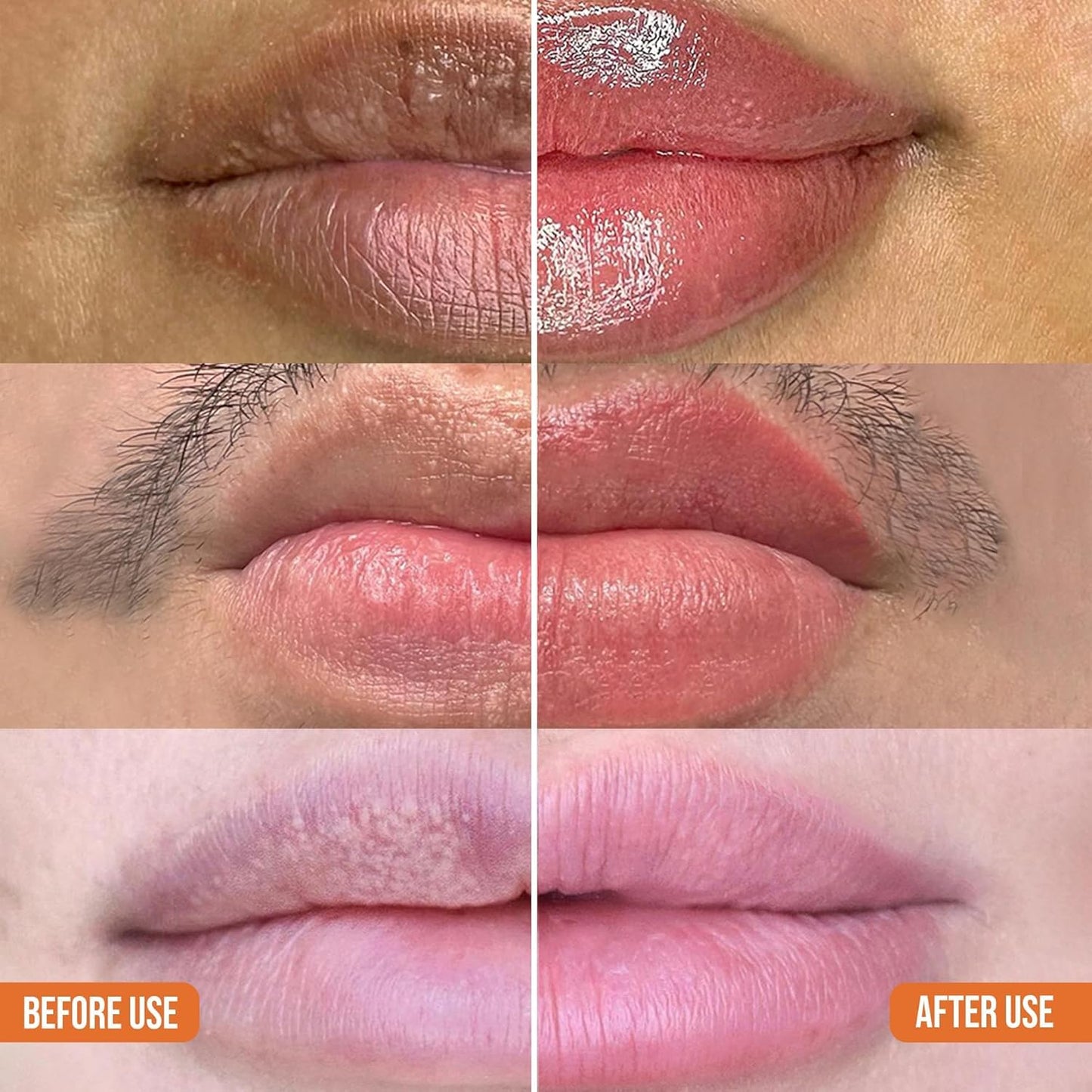 ABERA Fordyce Cream For Fordyce Spot, Fordyce Spot Remover For Men & Women, Lip Balm For Lightening & Brightening Dark Lips, Moisturizing Lip Plumper with Shea Butter