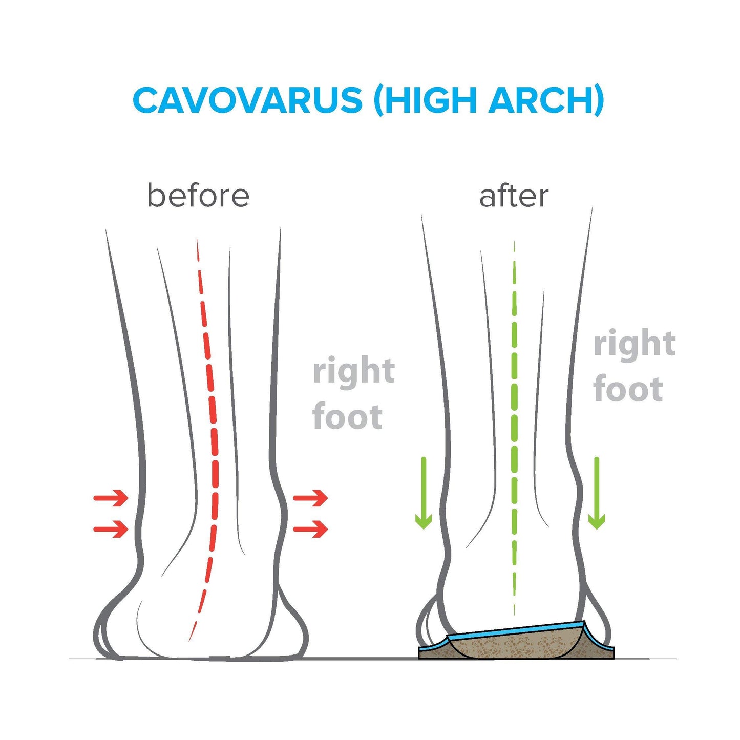 FootScientific® Arches Type 3 (High Arch) Orthotic Shoe Insoles (Men 11-11.5 / Women 13-13.5)