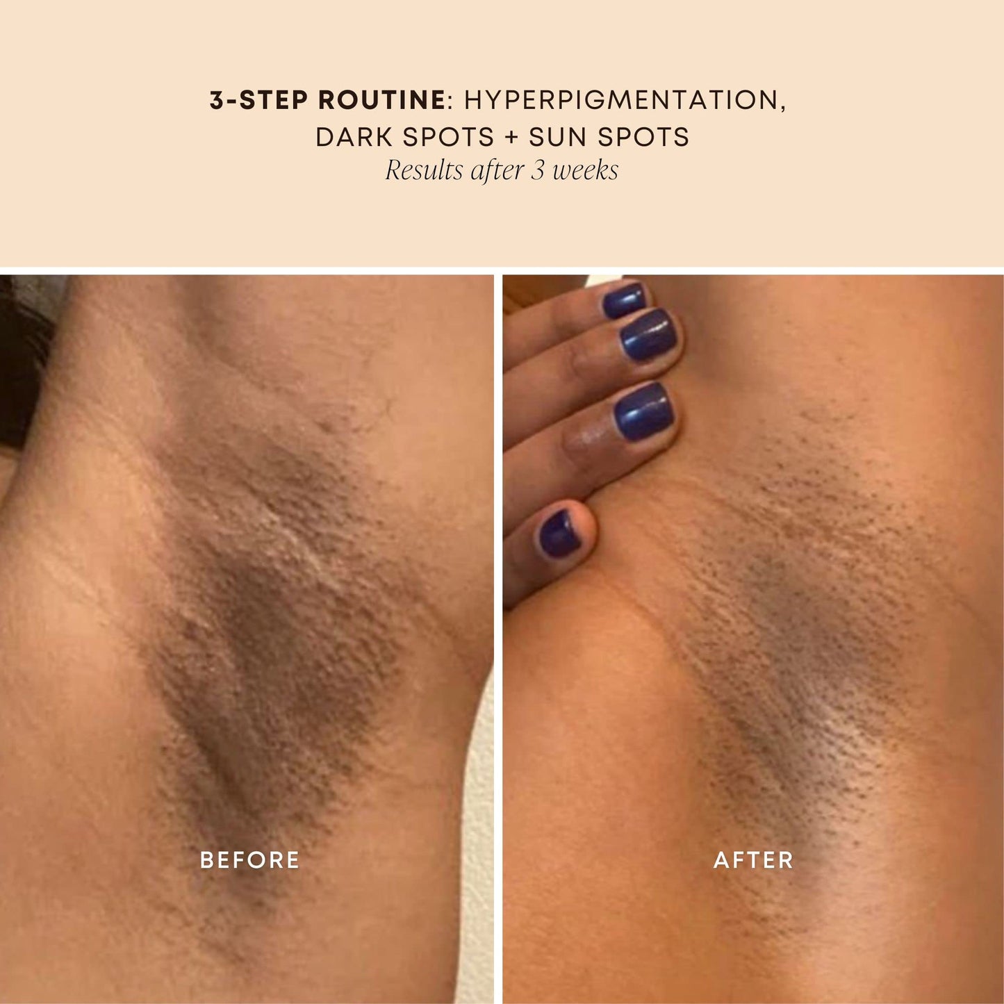 Bushbalm Dark Spots and Ingrown Hair 3 Step Routine - Rejuvenate and Nourish - Bermuda Oil Dark Spot Oil (30 ml), Bermuda Dark Spot Exfoliating Scrub (236 ml) and Nordic Dry Brush